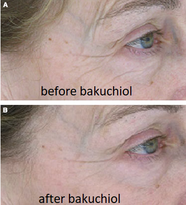 before and after bakuchiol